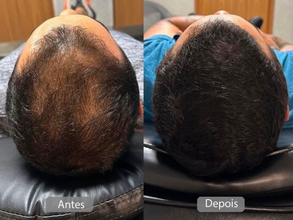 Resultado de tratamento capilar 1