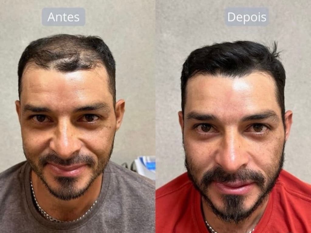 Resultado de tratamento capilar 2