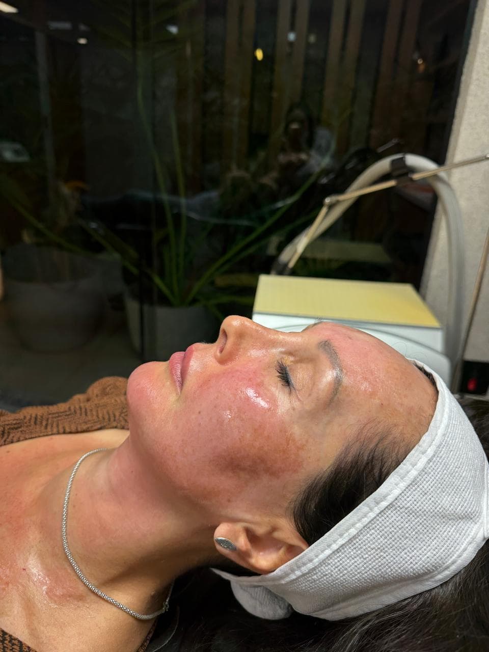 Resultado do PRP facial, pele revitalizada logo após a aplicação