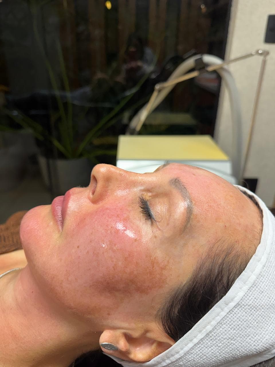 Detalhe da pele após o PRP facial